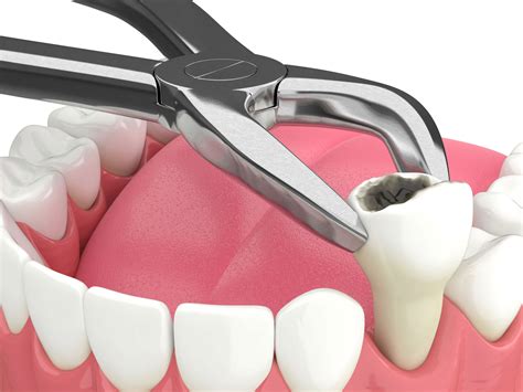 Oral Surgery Tooth Extraction Video At Carlos Wilson Blog