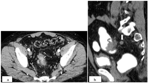 Incidental Detection Of Neuroendocrine Carcinoma Of Rectum During