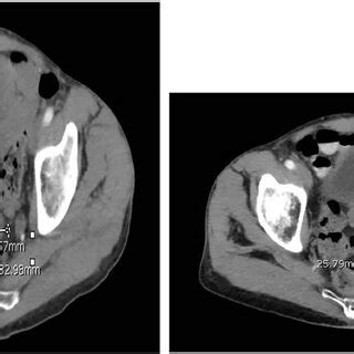 Ct Abdomen And Pelvis At A And B Months Follow Up The Pelvic