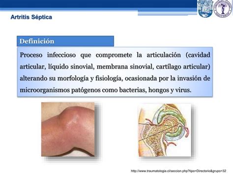 Artritis Septica Ppt