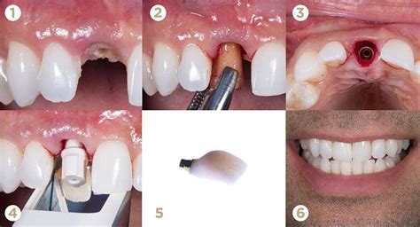 What You Need To Know About Peri Implantitis Implant Perio Center