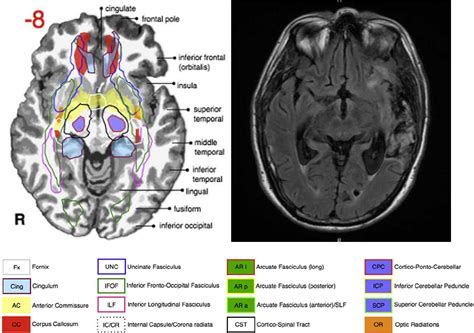 Lobes Of Brain Axial