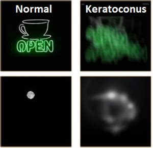 About Keratoconus - Keratoconus Australia - Keratoconus Australia