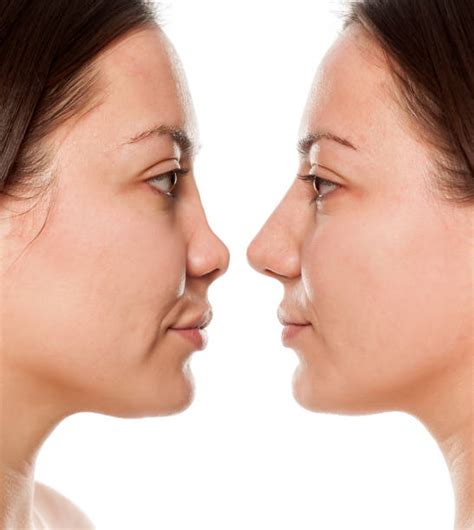 The Non Surgical Nose Job A Quick Path To Nasal Perfection Artemis