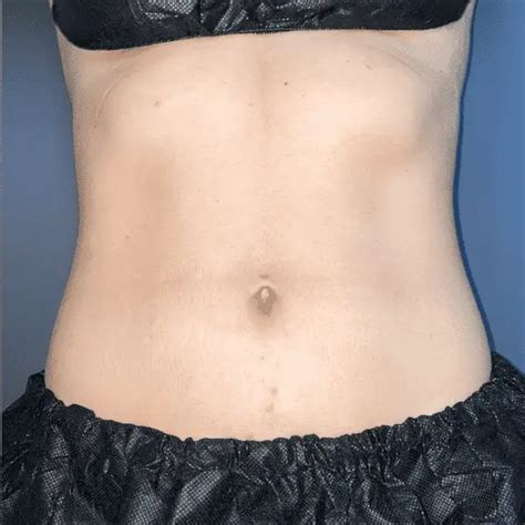 Eon Laser Miami Body Contouring Before And After 20 Off