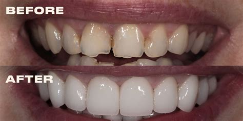 What Do Veneers Cost Dr Michael Apa Creates Veneers For Perfect Teeth