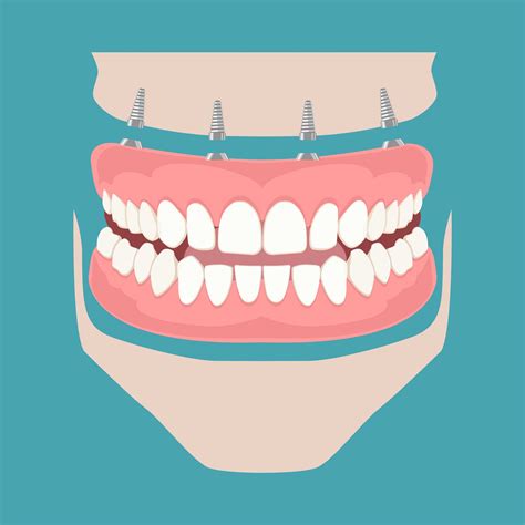 Understanding Full Arch Dental Implants | Falls Church, VA