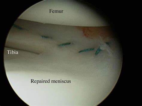 Arthroscopic Repair Of Meniscal Tears In Children And Teenagers Uw