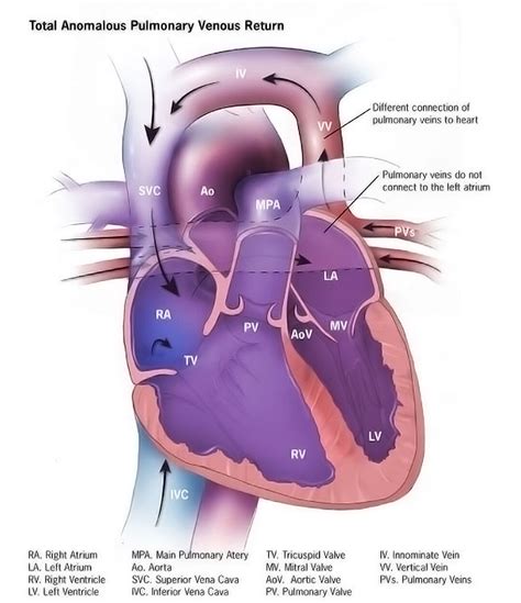 Total Anomalous Pulmonary Venous Return Overview Storymd