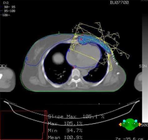 HDR Brachytherapy Combined With 3D Conformal Versus IMRT In Leftsided