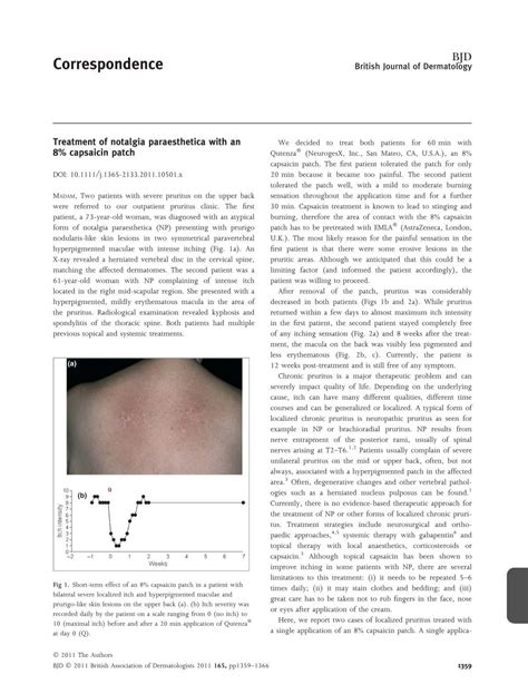 Treatment Of Notalgia Paraesthetica With An Capsaicin Patch