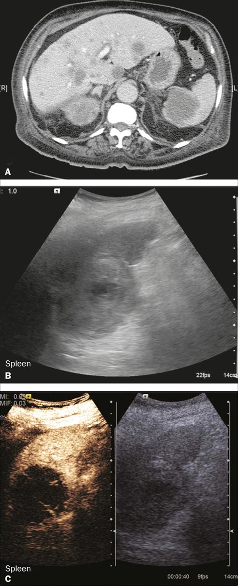 SciELO Brazil Common And Uncommon Features Of Focal Splenic Lesions