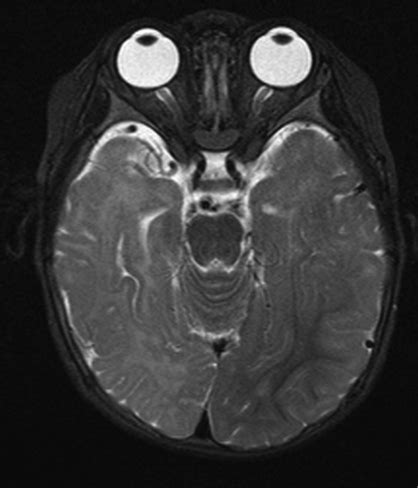 FOCAL CORTICAL DYSPLASIA