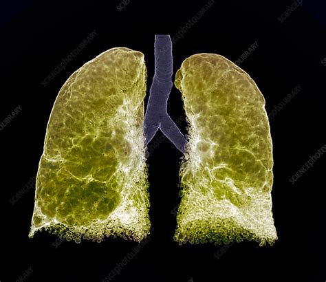 Emphysema, CT scan - Stock Image - C048/8769 - Science Photo Library