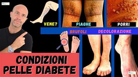 Le Condizioni Sulla Pelle Che Ti Dicono Che Hai Il Diabete Di Tipo