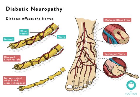 Diabetic Foot Assessment The Foot Hub Diabetic Podiatrist