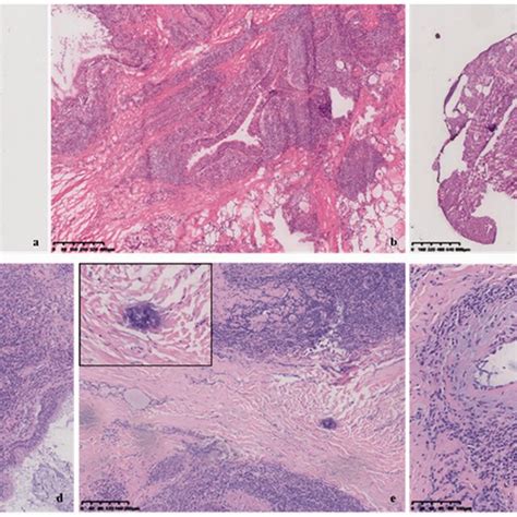 Pathological Findings In The Intraoperative Frozen Section Examination