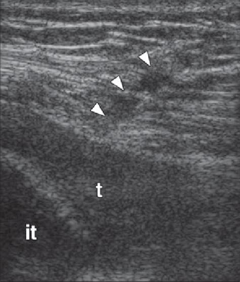 Year Old Man With Proximal Hamstring Tendinopathy Sagittal Ultrasound Download Scientific