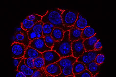 Tumore Al Pancreas Scoperto Meccanismo Di Sopravvivenza Inibizione