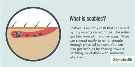 What Is Scabies? Learn About Its Causes, Symptoms And Treatment ...