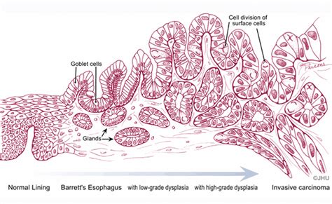 Dysplasia - Barrett's Esophagus | Johns Hopkins Pathology