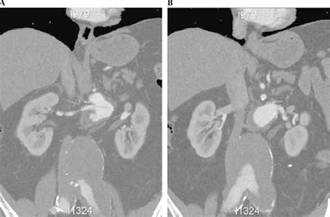 Figure From New Technique To Facilitate Renal Revascularization With