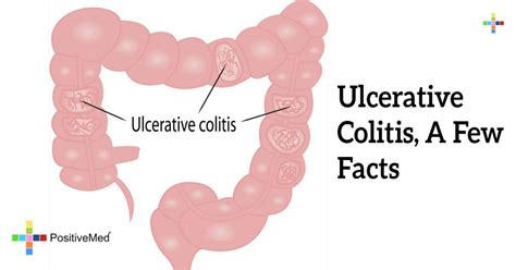 Ulcerative Colitis A Few Facts Positivemed