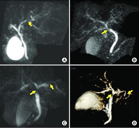 Magnetic Resonance Cholangiography Suggesting Definite Changes Of SC