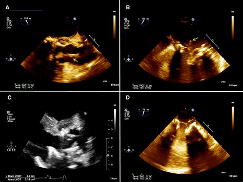 A 2d Preoperative Transesophageal Echocardiography Tee Showing The Download Scientific