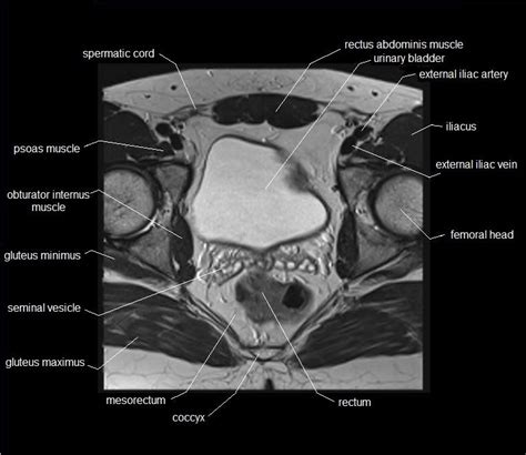 Mri Pelvis Anatomy Free Male Pelvis Axial Anatomy Pelvis Anatomy