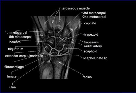 Mri Wrist Coronal Anatomy Wrist Tendon And Ligaments Anatomy Cross ...