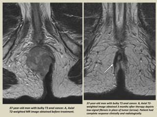 Presentation1 Radiological Imaging Of Anal Carcinoma PPT