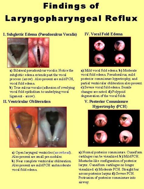 Laryngopharyngeal Reflux Lpr Treatment For Heartburn Home Remedies