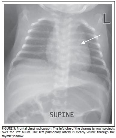 Pitfalls And Mimics The Many Facets Of Normal Paediatric Thymus