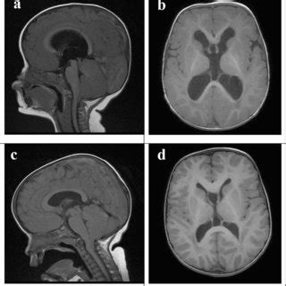 Skull radiography and MRI performed 2 months after the initial VP shunt... | Download Scientific ...