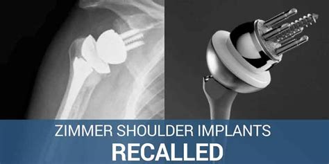 FDA Grants Fast Approval To Recalled Zimmer Shoulder Implants