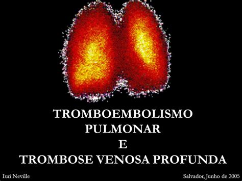 Tromboembolismo Pulmonar E Trombose Venosa Profunda Ppt Carregar