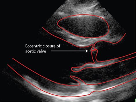 Bicuspid Aortic Valve Critical Care Sonography