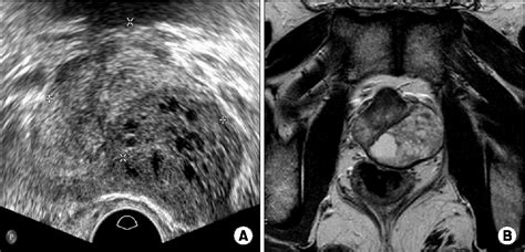 [pdf] A Case Of Laparoscopic Radical Prostatectomy For A Prostatic