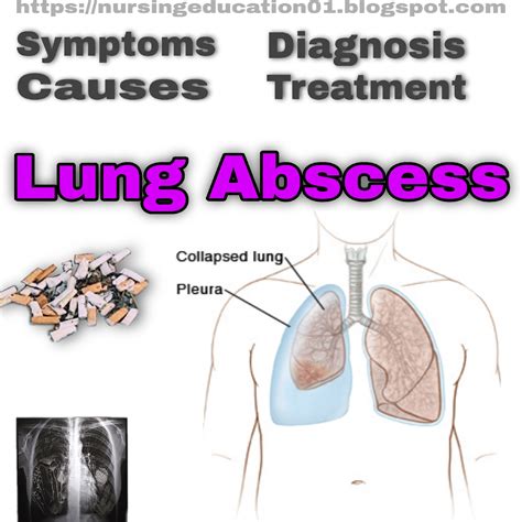 Nursing study material: Lung Abscess: Symptoms, Causes, Diagnosis ...