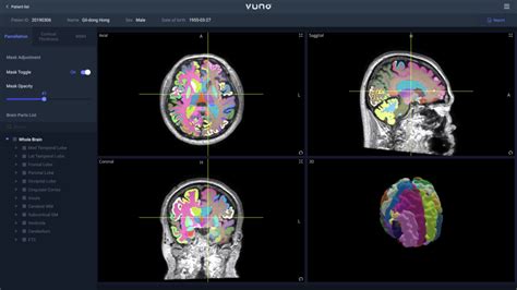 치매 조기 진단도 인공지능으로 뷰노 뇌 Mri 기반 Ai 치매 조기 진단 솔루션 상용화