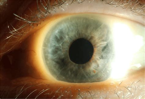 Postoperative Slit Lamp Photo Of The Left Eye Showing A Clear Cornea