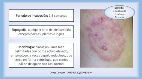 Dermatofitosis Tiñas Ppt