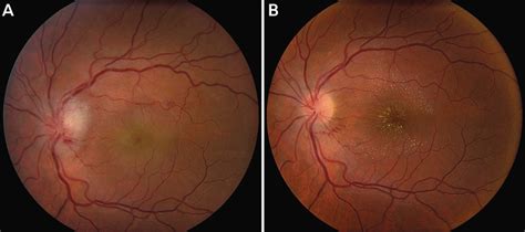 Infectious Optic Neuropathies Continuum Lifelong Learning In Neurology