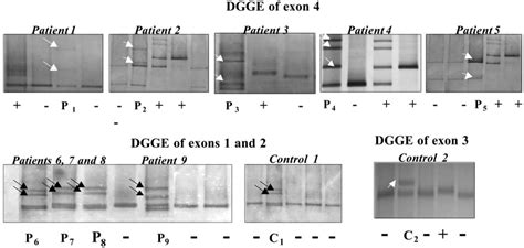 DGGE Analysis Of Exons 1 And 2 Exon 3 And Different Fragments Of Exon