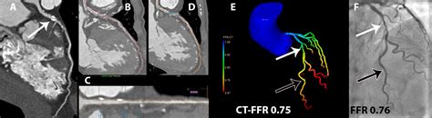 Diagnostic Performance Of On Site Coronary Ct Angiographyderived