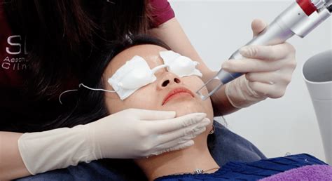 5 Surprising Benefits Of Pico Laser You May Not Know Sl Aesthetic Clinic