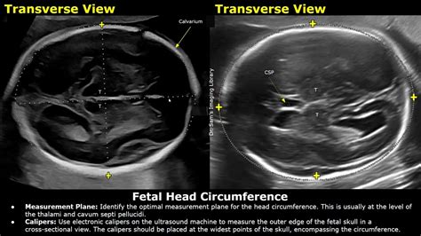 How To Measure Fetal Head Circumference Hc On Ultrasound Biometric Parameters Obstetric