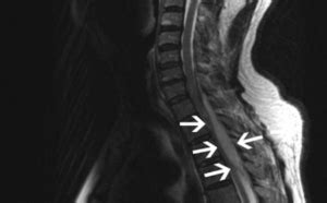 EPIDURAL ABSCESS - Longhorn Brain and Spine