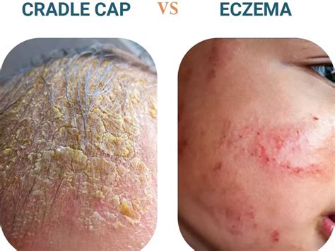 Seborrheic Dermatitis Eczema Telling The Difference 43 Off